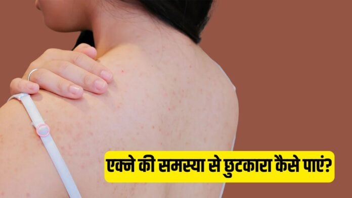 पीठ पर निकलने वाले मुंहासों से हैं परेशान? इन तरीकों से पाएं छुटकारा